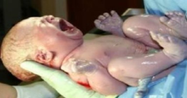الولادة القيصرية