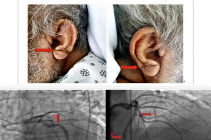 علامة بالأذن تنذر بمرض خطير في القلب