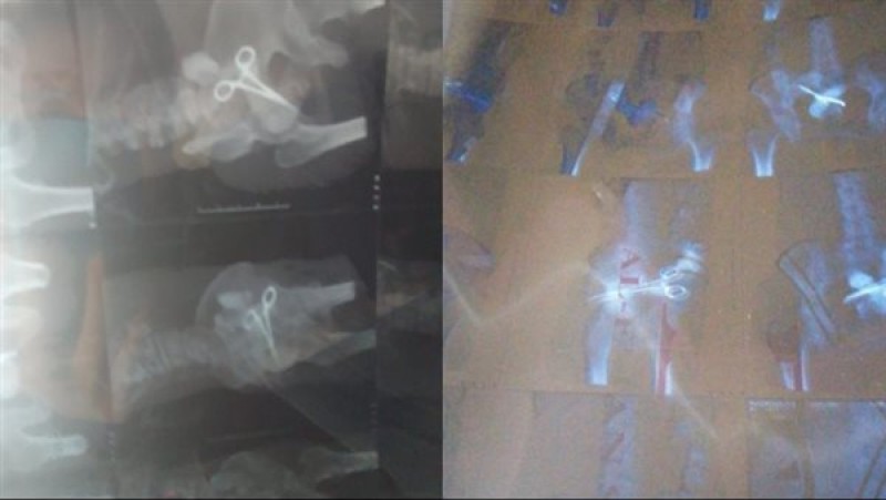 صورة من الإشعة التي تظهر وجود الجيفت الطبي