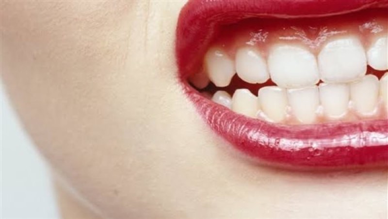 الأسنان البيضاء