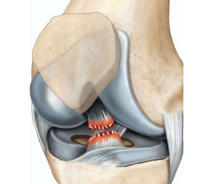 أسباب إصابة الرباط الصليبي في الركبة وطرق العلاج من خلال العمليات الجراحية